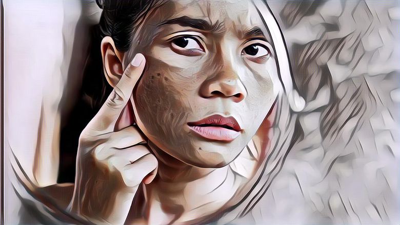 5 Cara Ampuh Agar Flek Hitam di Wajah Memudar