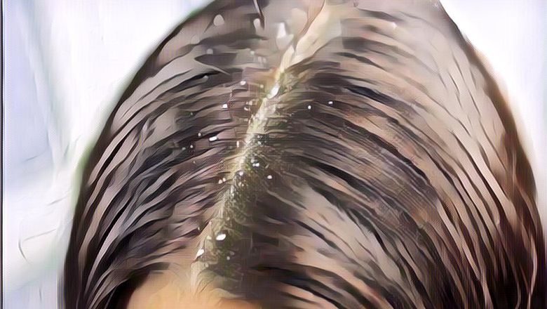 Tak Banyak yang Tahu, Ketombe Punya 4 Jenis yang Berbeda Lho!