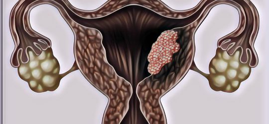 Selain Vaksin, Ini 5 Makanan yang Bisa Cegah Kanker Serviks