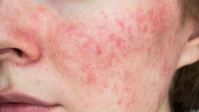 1. Wajah Tampak Kemerahan