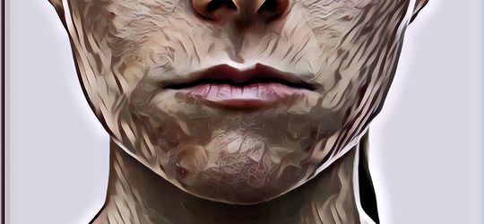 Ini Perbedaan Gejala dan Penanganan antara Kulit Sensitif dan Kulit Berjerawat Menurut Dokter Kamila Jaidi