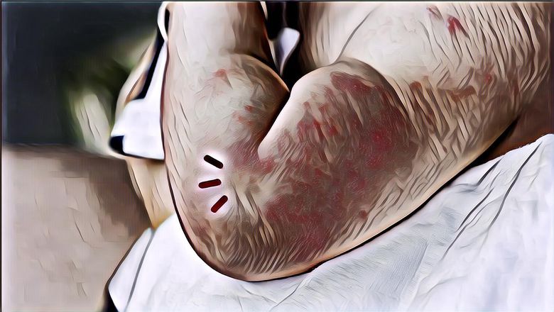 Waspada! Ruam Kulit Bisa Jadi Tanda 5 Penyakit Serius Lho, Apa Aja?