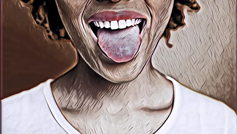 Covid Tongue, Sariawan Juga Bisa Jadi gejala Corona Ini Bedanya  Dengan yang Biasa