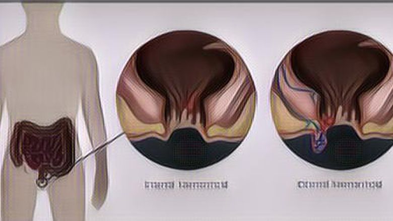 Penyebab dan Gejala Umum Ambeien atau Wasir, Bisakah Sembuh Sendiri?
