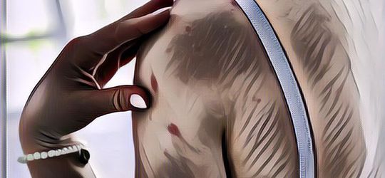 Frustrasi dengan Jerawat di Punggung? Begini 7 Cara Jitu Mengatasinya Ladies