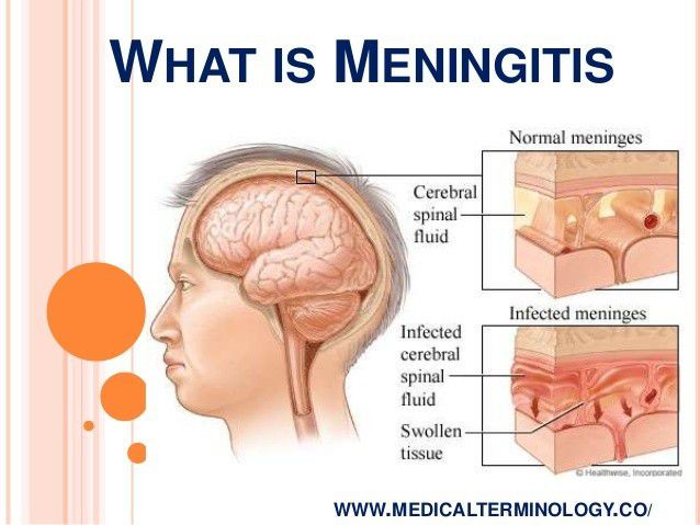 Apa itu meningitis?