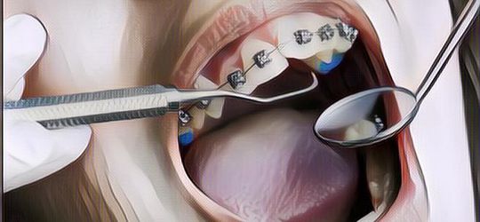 Begini Cara Merawat Gigi Yang Dipasangin Behel~