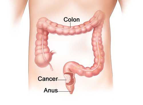 # Orang yang Berisiko Terserang Penyakit Kanker Usus Besar