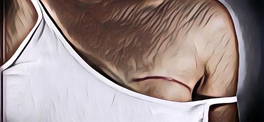 7 Cara Cegah Kanker Payudara, Sadari Sedari Dini Sebelum Terlambat