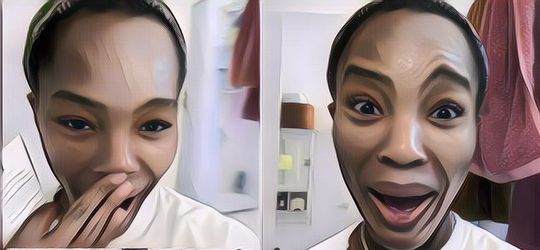 Gara-Gara Suntik Botox, Alis Wanita Ini Malah Mirip Logo Nike