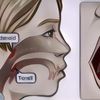 Apakah Adenoid Bisa Sembuh Sendiri?