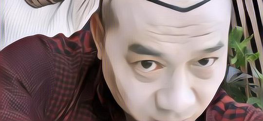 Coba Pikir-pikir Dulu, Ini Efek Samping Lakukan Transplantasi Rambut