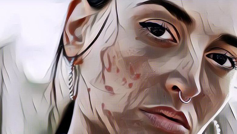 Jangan Dianggap Sepele, Jerawatan Bisa Jadi Pertanda 3 Penyakit Serius Ini!