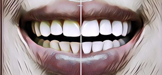 Percaya Diri Meningkat Tajam dengan 5 Cara Memutihkan Gigi Berikut Ini, Cobain Yuk!