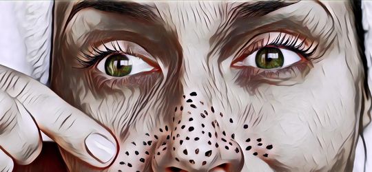 4 Cara Simpel Atasi Komedo di Kulit Wajah Buat Si Super Sibuk