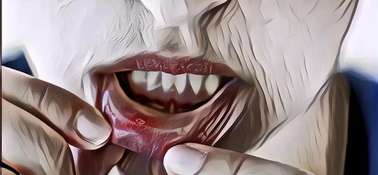 Gak Perlu ke Apotek, Pakai 10 Obat Alami Ini untuk Sembuhkan Sariawanmu