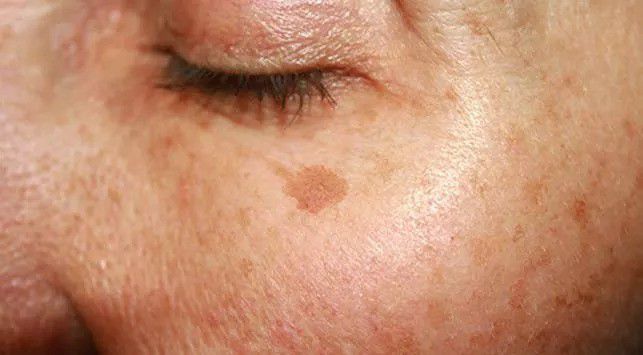 2. Timbul Bercak-Bercak Coklat