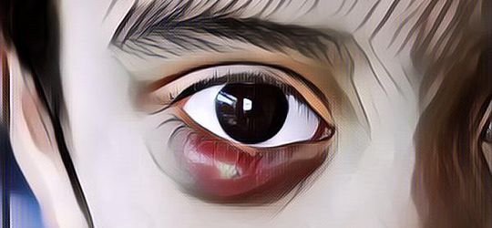 Cara Menghilangkan Bintitan: Cuma Ini Cara yang Paling Cepat dan Ampuh