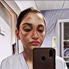 Viral Foto-foto Wajah Para Dokter dan Tenaga Medis Dunia Selama Bertugas Merawat Pasien Terinfeksi Covid-19