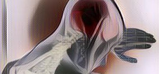 Mengenal Apa itu Aneurisma Otak yang Menyerang Pria Surabaya yang Hampir Tewas Saat Bercinta