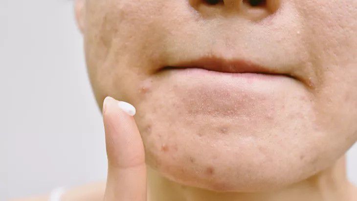 1. Mengaplikasikan Obat Jerawat Berkali-kali