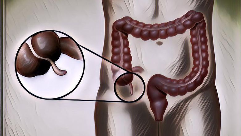 Sebenarnya Apa Penyebab Penyakit Usus Buntu dan Bagaimana Mencegahnya?