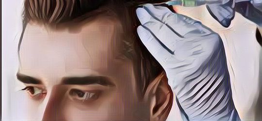 Kenalan dengan Istilah Cangkok Rambut Seperti yang Dilakukan Kevin Aprilio