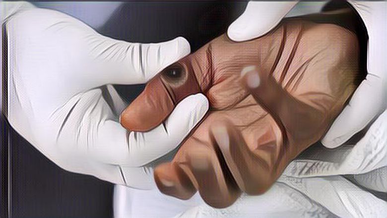 Bikin Was-Was, Kasus Cacar Monyet di RI Semakin Meningkat!