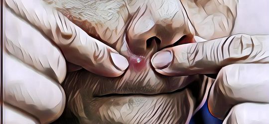 STOP! Ini Bahaya Memencet Jerawat yang Mungkin Kamu Tidak Tahu