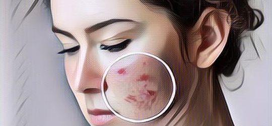 Apa Saja Suplemen Makanan untuk Kulit Berjerawat? Cari Tahu di Sini