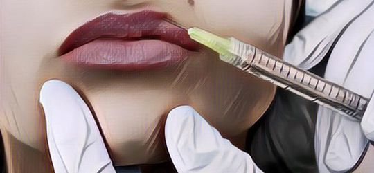 Suntik Botox Mendekati Hari Pernikahan, Nasib Bibir Wanita Ini Malah Jadi Begini