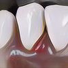 Gusi Belakangmu Bengkak dan Sakit Saat Menelan? Bisa Jadi Kamu Menderita Gingivitis, Kenali Gejalanya!