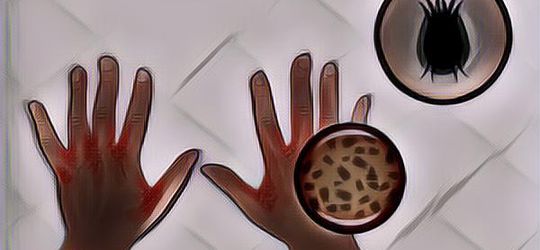 Mengenal Apa Itu Scabies, Gatal-Gatal Tapi Kok Bisa Menular ke Orang Lain