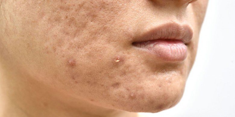 # Cara Mengatasi Jerawat di Dagu