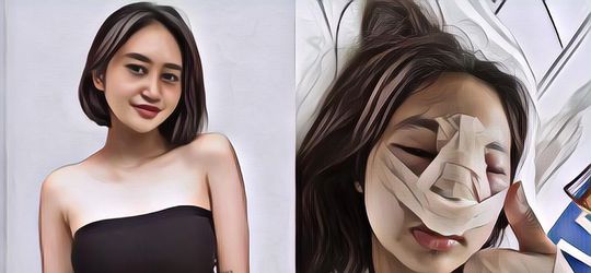 Oplas Demi Hidung Mancung, Anak Farida Nurhan Alami Infeksi Implan Parah Dan Bengkak Dari Mata Sampai Pipi, Gini Kondisinya!