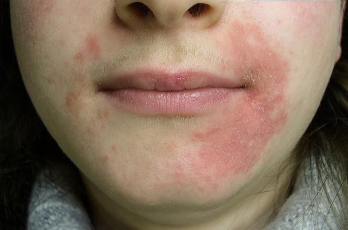 # Gejala Dermatitis Seboroik