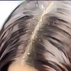 Ini Dia 4 Jenis Ketombe pada Rambut yang Jarang Diketahui
