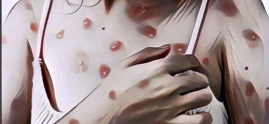 Ada 16 Kasus Aktif Cacar Monyet di DKI Jakarta, Ini Ciri-Cirinya