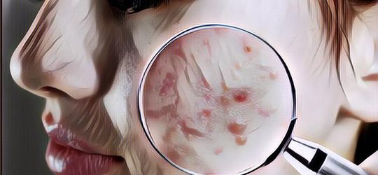 Cara Atasi Muka Jerawatan pada Kulit Remaja, Demi Tampil Percaya Diri!