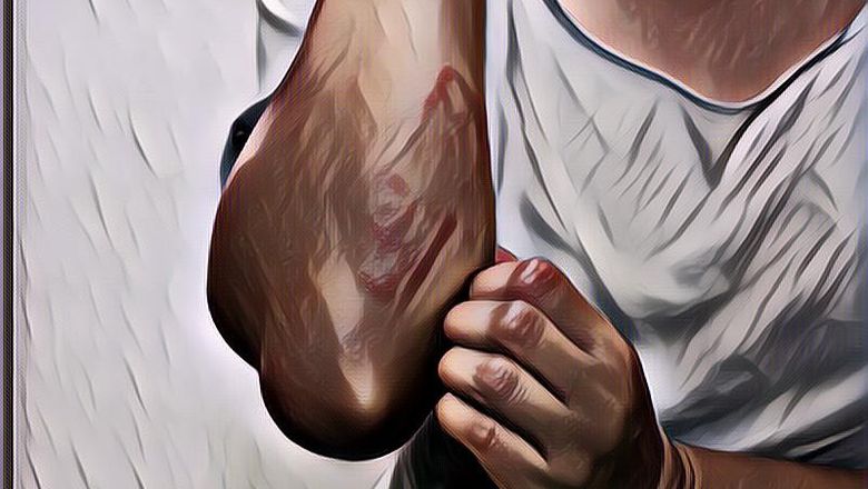 Gejala, Penyebab, dan Cara Mengobati Penyakit Kulit Prurigo atau Darah Manis