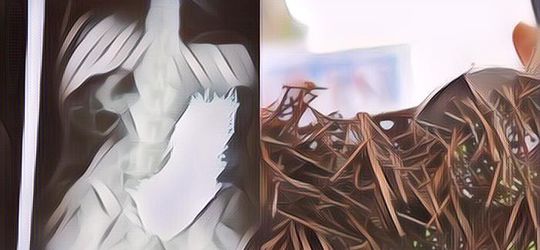 Aneh Tapi Nyata! Perut Seorang Pria Ini Jadi Sarang 600 Paku Karatan, Gimana Ceritanya Sih?