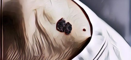 Mengenal Melanoma, Jenis Kanker Kulit Paling Berbahaya yang Bisa Memicu Kematian