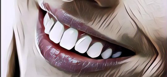 Niat Pengen Cantik, Wanita Ini Malah Dibilang Mirip Kuda Usai Lakukan Veneer Gigi Rp 73 Juta