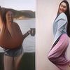 Kasihan, Wanita Ini Idap Penyakit Tak Umum, Payudaranya Terus Tumbuh Hingga 10 Kg