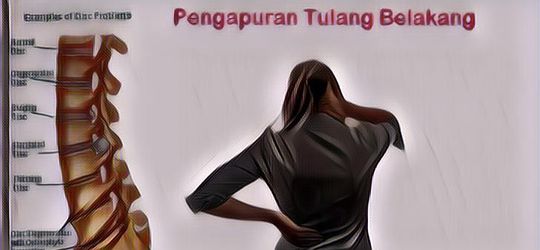 Penyebab Pengapuran Tulang Belakang yang Bisa Menyerang Usia Berapa Pun