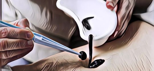 Meski Bikin Geli Ternyata Terapi Lintah Banyak Manfaatnya untuk Kesehatan! Apa Saja?