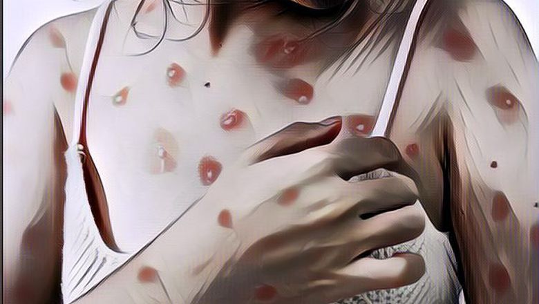 Ada 16 Kasus Aktif Cacar Monyet di DKI Jakarta, Ini Ciri-Cirinya