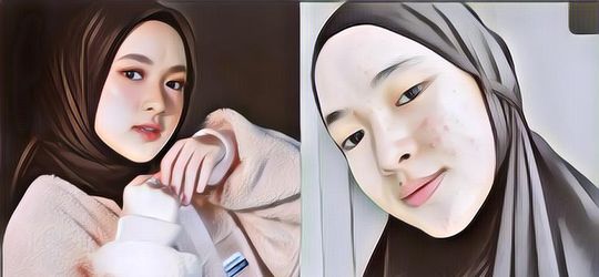 Viral Wajah Nissa Sabyan Diperban Karena Jerawat, Begini Faktanya