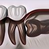 Penyebab Impaksi Gigi dan Cara Mencegahnya