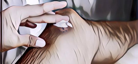 Pakai Herbal Aja! Ini Cara Mengobati Bisul Agar Cepat Kempes